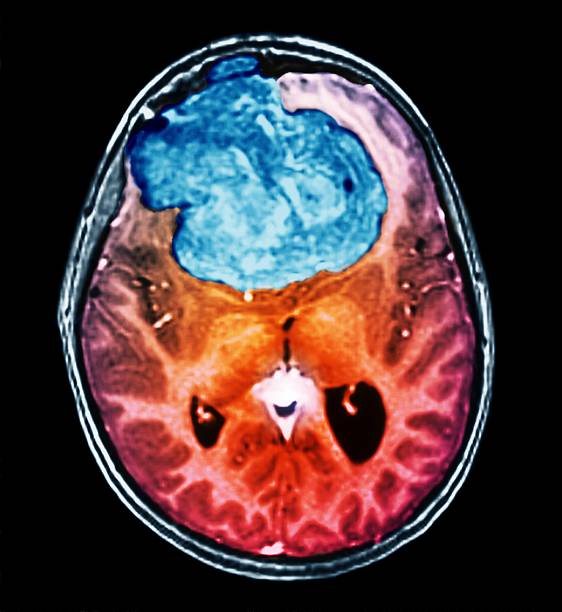 Brain Tumor Detection App